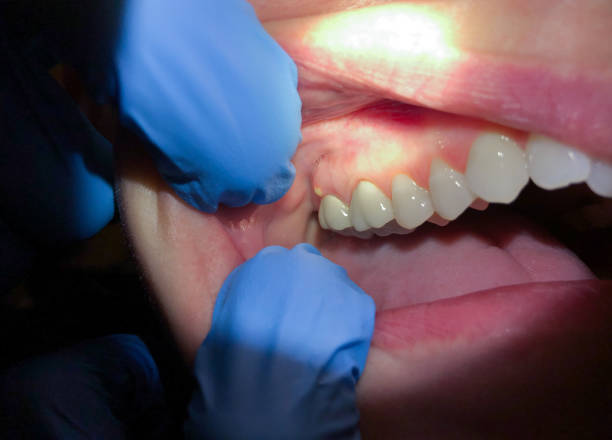 Best Emergency Dental Care for Abscessed Tooth in Comstock Park, MI